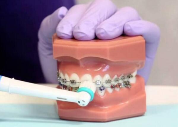 戴了牙套怎么使用電動牙刷？正確使用牙刷很重要